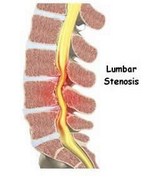 spinal stenosi--West Hollywood chiropractic